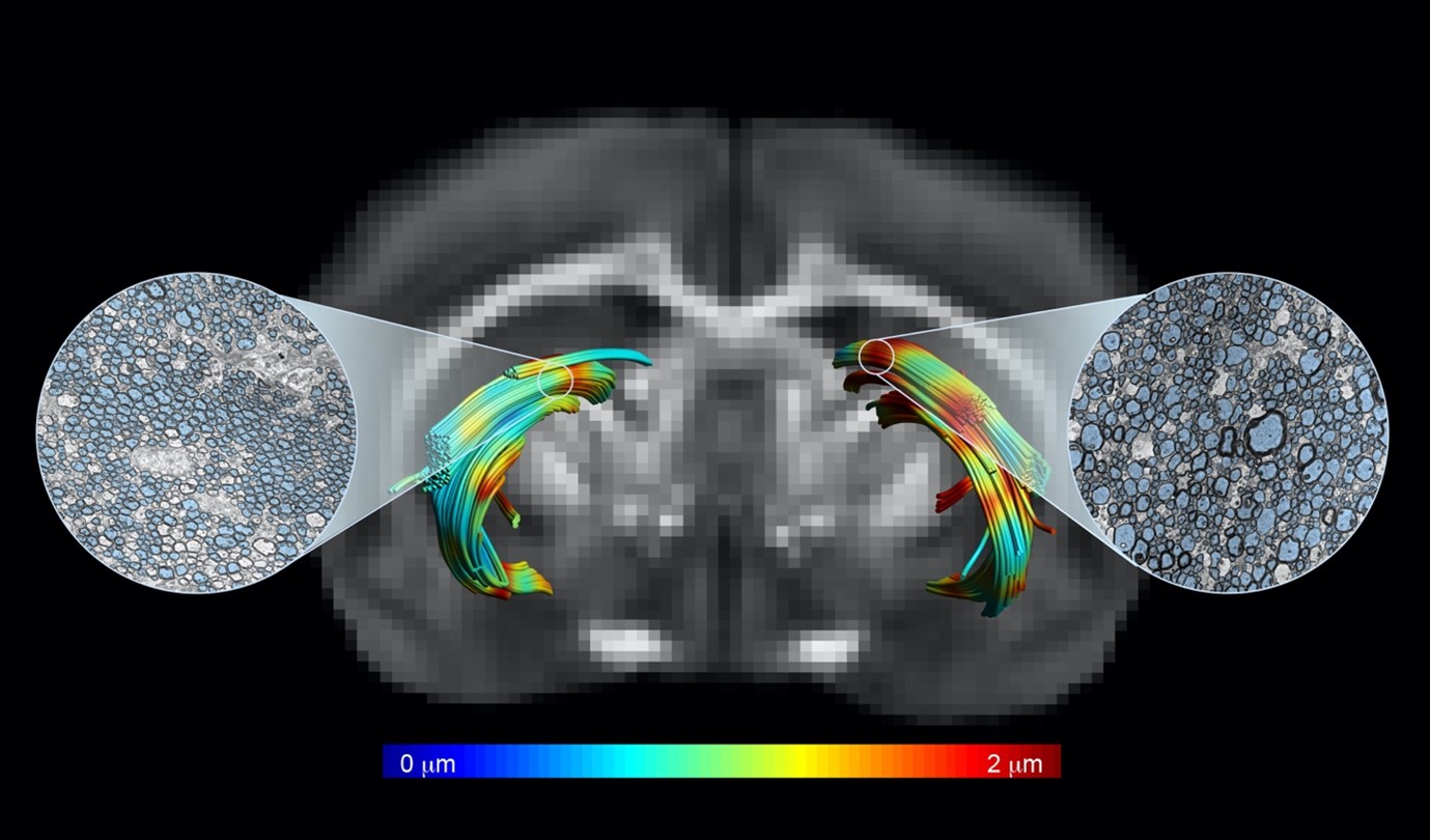 09-01-23-Dano-axonal-MRI-1
